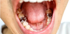 dental fillings Adelaide